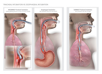 Tracheal Intubation vs. Esophageal Intubation