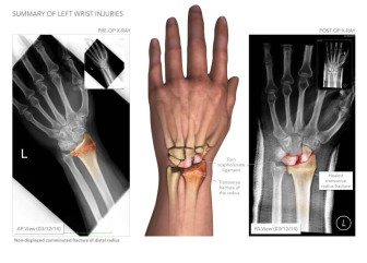 Wrist Injuries and Surgery