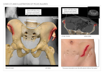 X-Ray, CT, and Illustration of Pelvis Injuries
