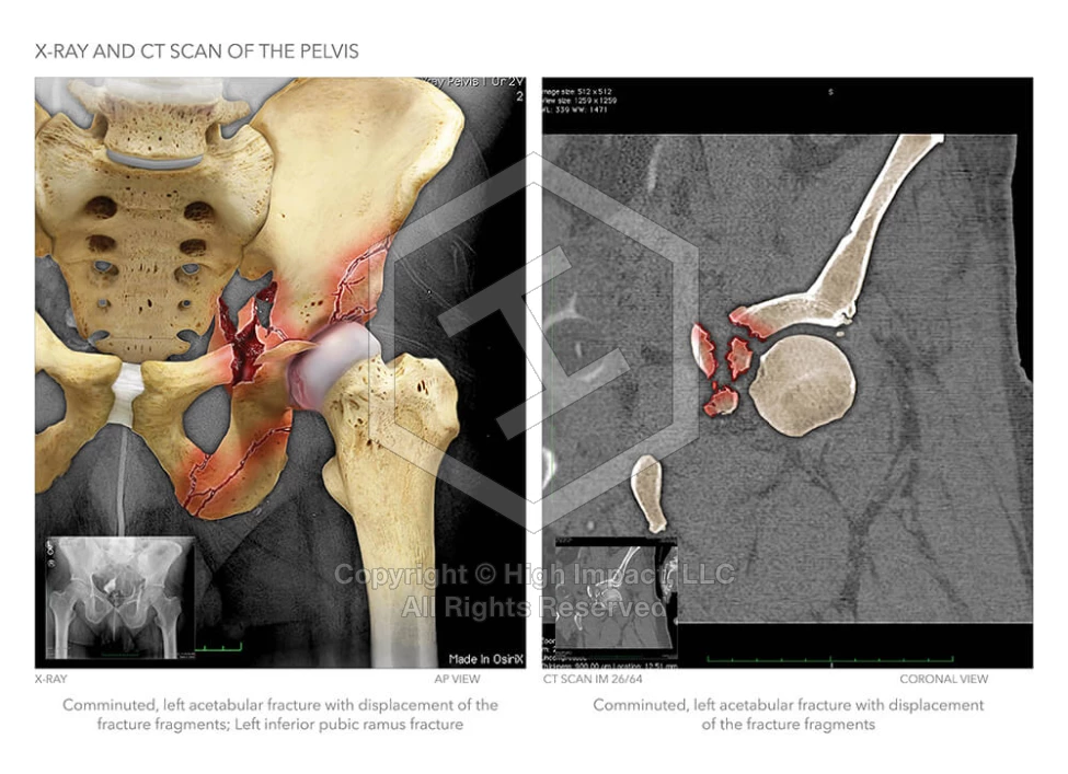 X-Ray and CT Scan Showing Complex Pelvic Injuries
