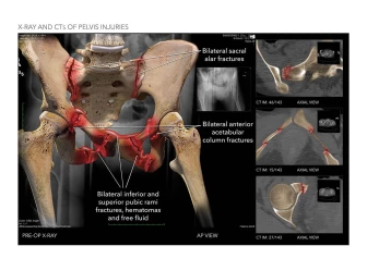 X-Ray and CTs of Pelvis Injuries