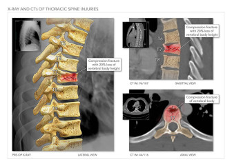 X-Ray and CTs of Thoracic Spine Injuries