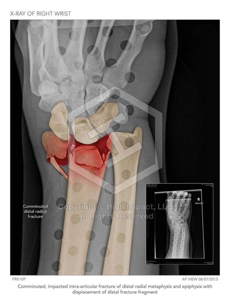 X-Ray of Fractured Wrist