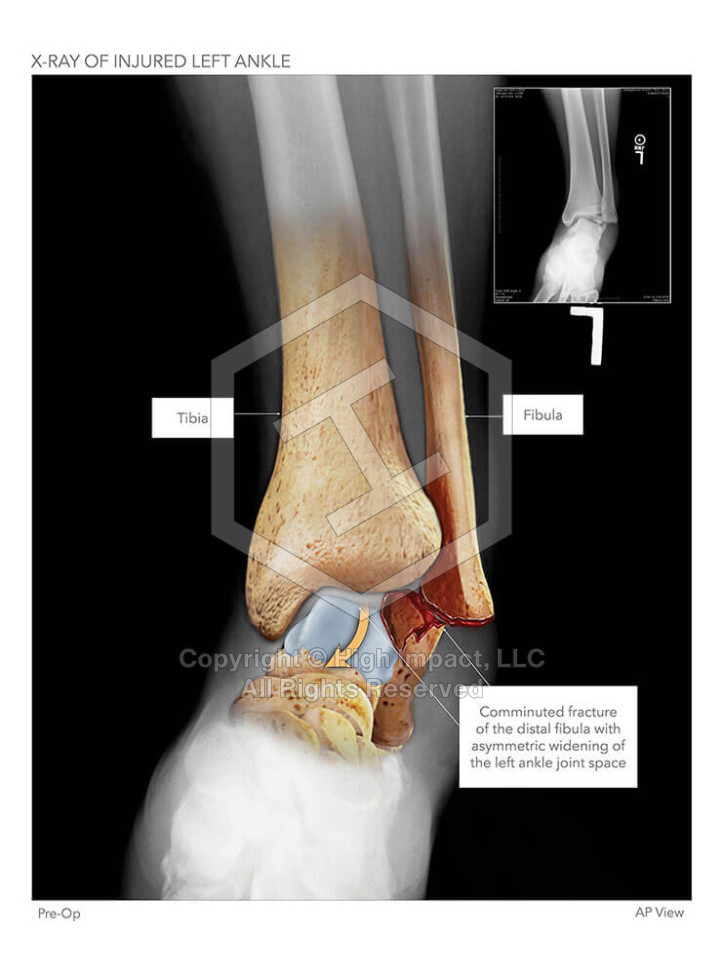 X-Ray of Injured Left Ankle