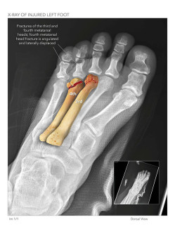 X-Ray of Injured Left Foot