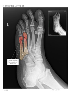 X-ray of the Left Foot
