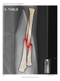 X-Ray of the Left Forearm