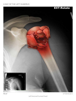 X-Ray of the Left Humerus