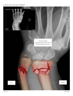 X-Ray of the Left Wrist