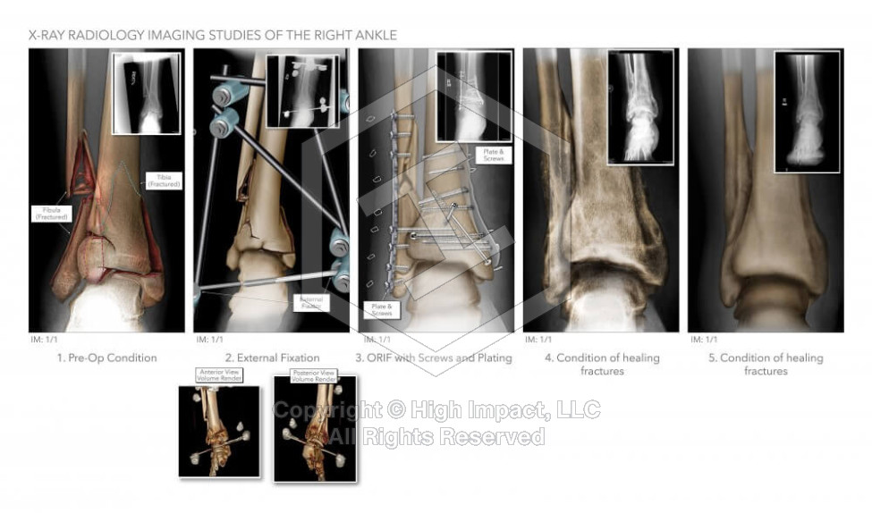 X-Ray Radiology Imaging Studies of the Right Ankle