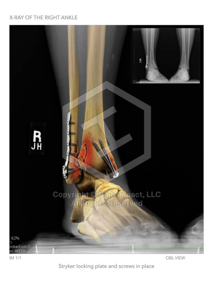 X-Ray of the Right Ankle