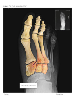 X-ray of the Right Foot