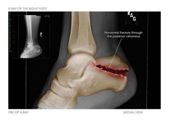 X-Ray of the Right Foot