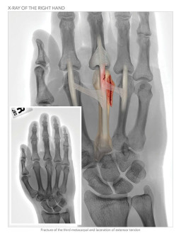 X-Ray of the Right Hand