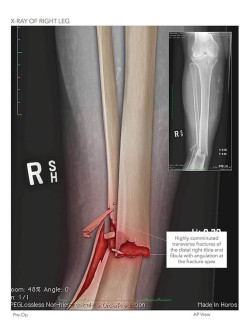 X-Ray of Right Leg