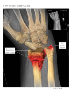 X-ray of Right Wrist Injuries
