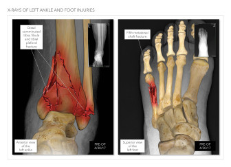 X-rays of Ankle and Foot Injuries