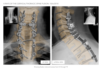 X-Rays of Cervical/Thoracic Spine Fusion