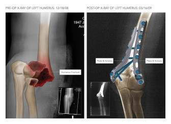 X-Rays of the Elbow