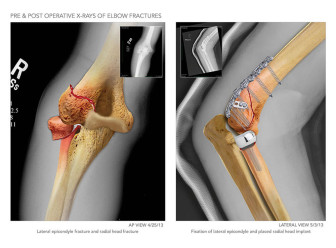 X-Rays of the Elbow