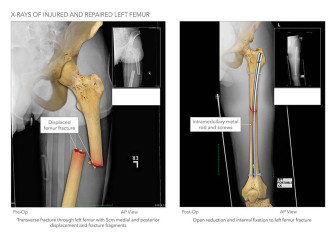 X-Rays of Injured and Repaired Left Femur