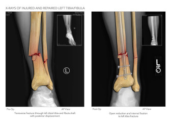 X-Rays of Injured and Repaired Left Tibia and Fibula