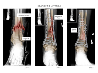 X-Rays of the Left Ankle