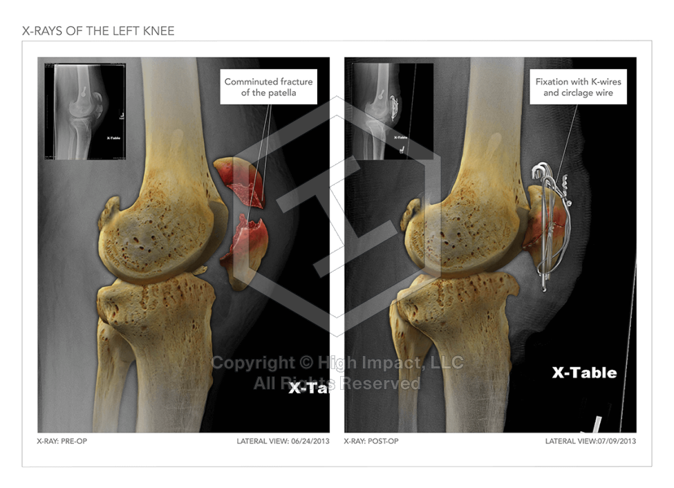 X-Rays of The Left Knee