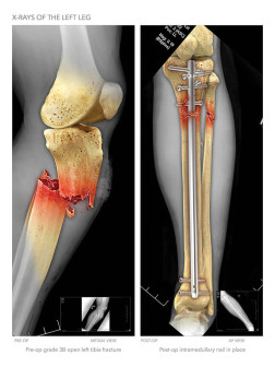 X-Rays of the Left Leg
