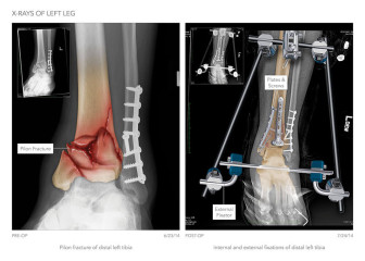 X-Rays of Left Leg