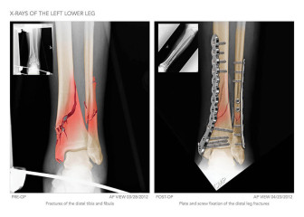 X-Rays of the Lower Leg