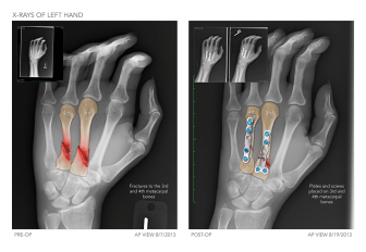 X-Rays of Right Hand