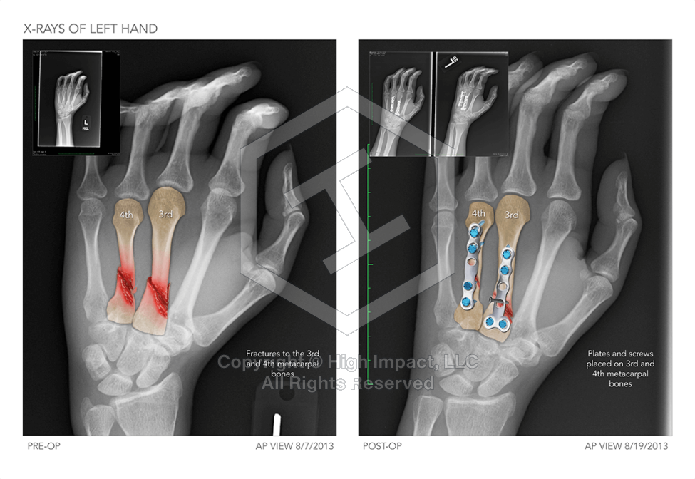 X-Rays of Right Hand